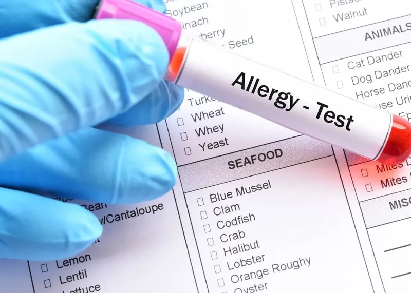 Skin prick allergy test drops being placed on a patient's forearm during testing