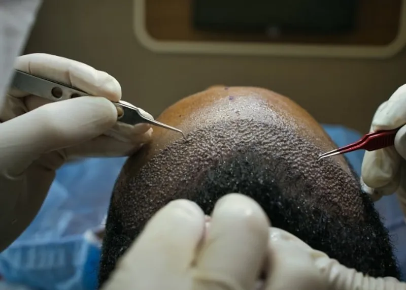 Treatment room prepared for a procedure at a licensed hair clinic in Istanbul
