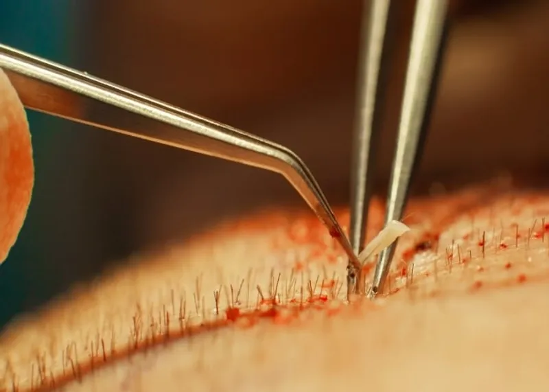 Close-up of the donor area at the back of the scalp being assessed before graft extraction