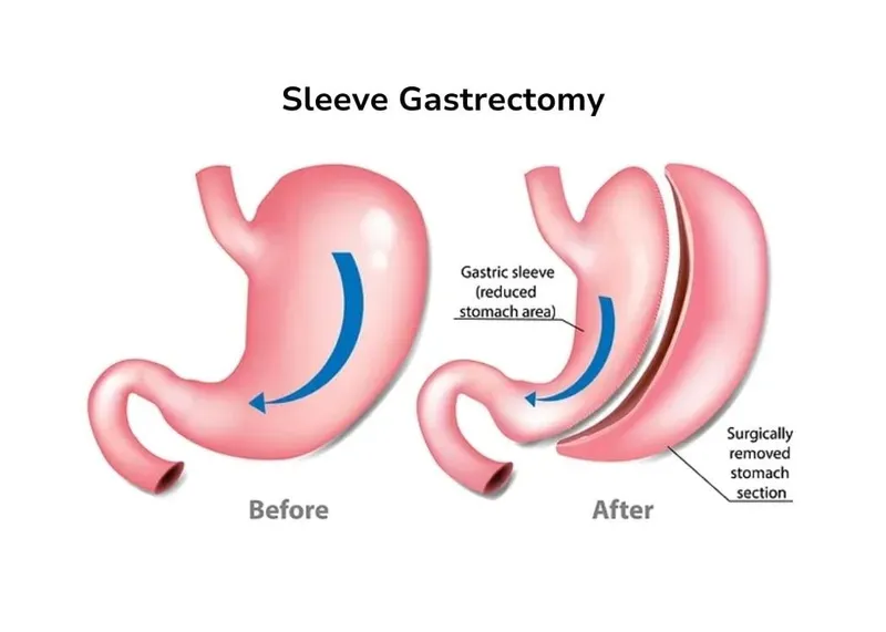 Illustration of a sleeve gastrectomy, showing the smaller tube-shaped stomach left after surgery.