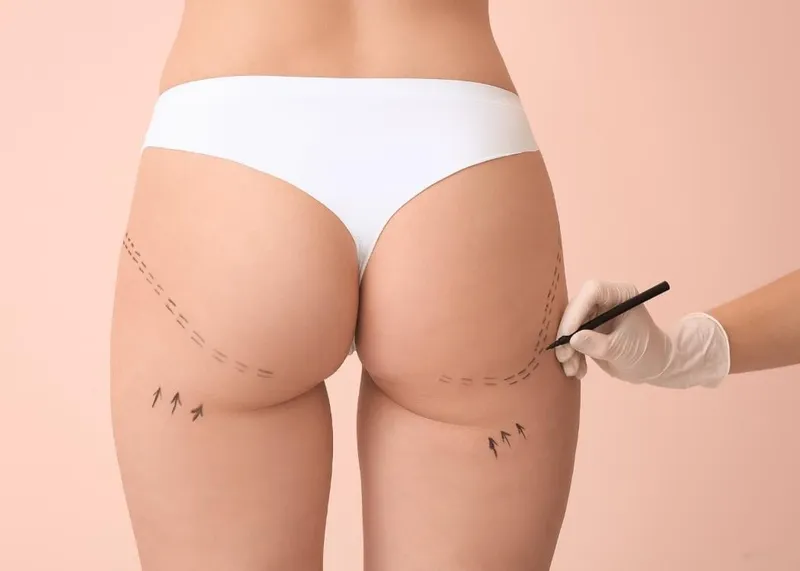 Buttock augmentation with fat grafting performed at a body aesthetics clinic in Istanbul.