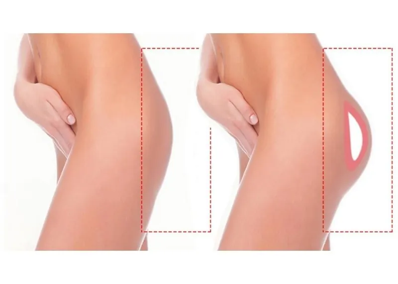 Buttock implant surgery showing the difference between round and anatomical implant options.