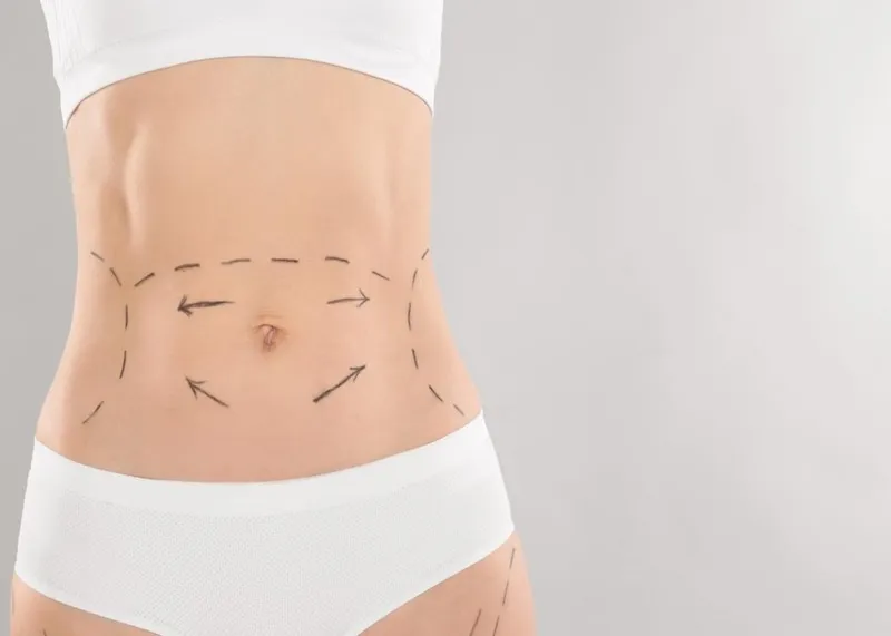Tummy tuck (abdominoplasty) procedure for abdominal contouring and excess skin removal.