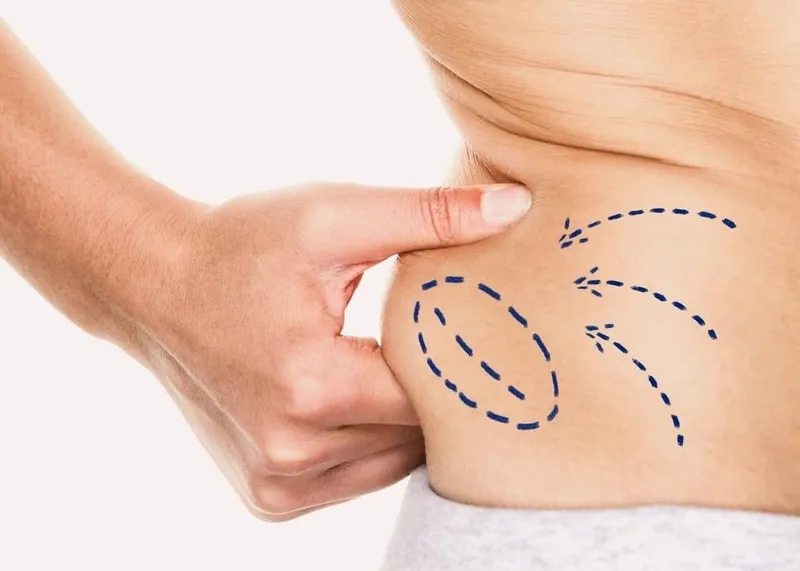 Laser liposuction session targeting localized fat deposits for body contouring.