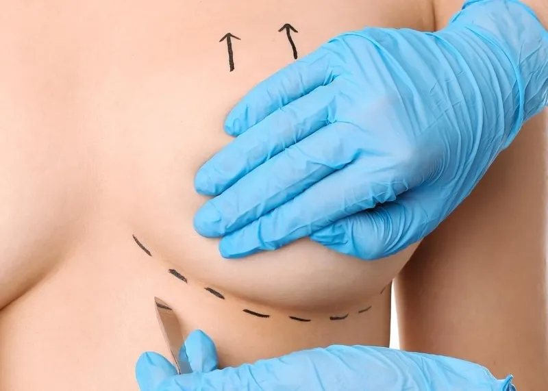 A surgeon examines a patient during a planning consultation before a breast lift (mastopexy) procedure.