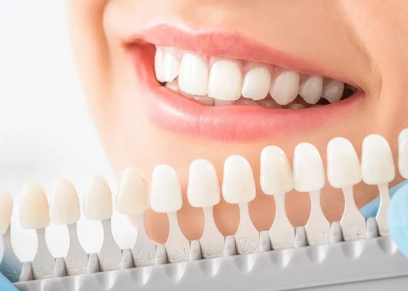 Close-up of a bright smile after a professional teeth whitening session
