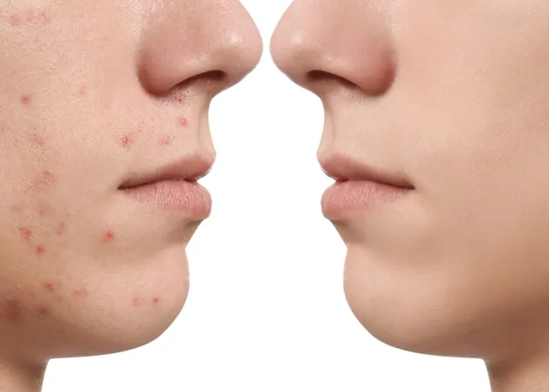 Dermatologist examining acne on a young patient's face before treatment