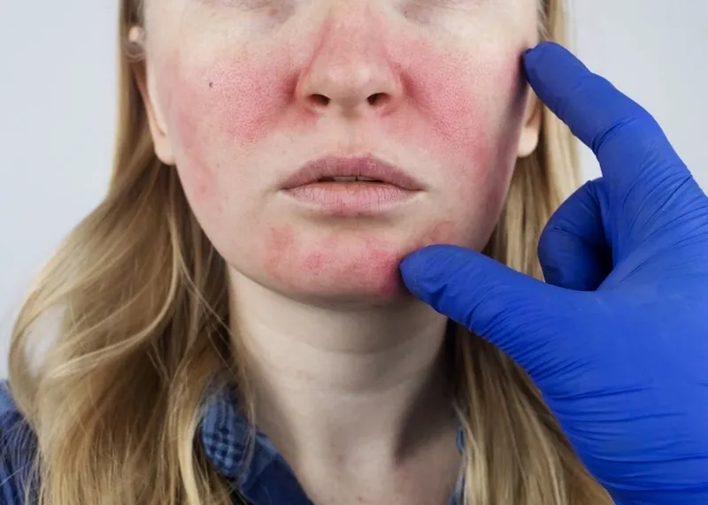 Woman with facial redness consulting a dermatologist about rosacea treatment