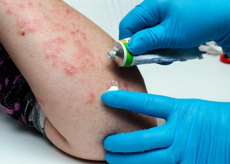 Moisturizing cream being applied to eczema-affected skin on a patient's arm