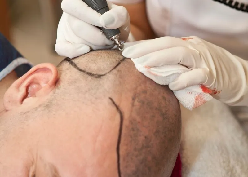A specialist plans the hairline design and graft placement before hair transplant surgery.