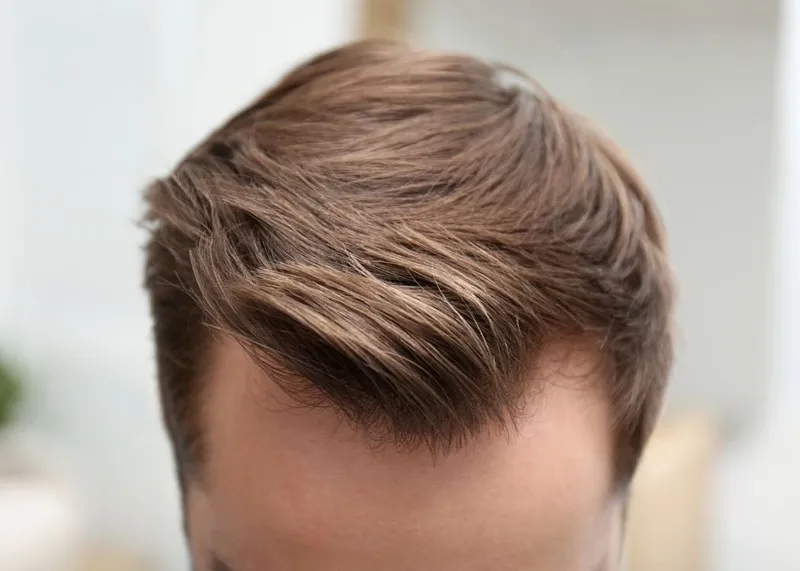 A doctor examines a patient's scalp to assess the extent and cause of hair loss.