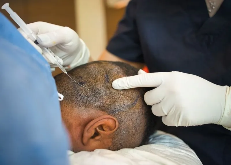 A medical illustration of donor and recipient areas of the scalp in hair transplantation.