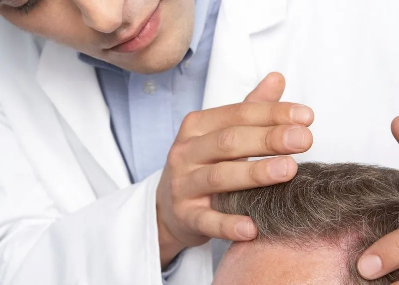 A surgeon extracts follicular units from the donor area during an FUE hair transplant.