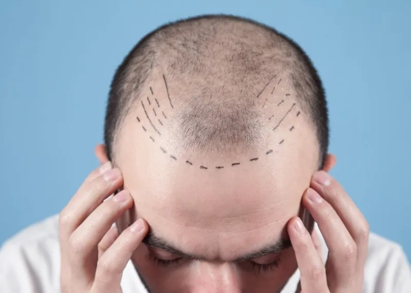 A clinic coordinator reviews a hair transplant treatment package with an international patient.