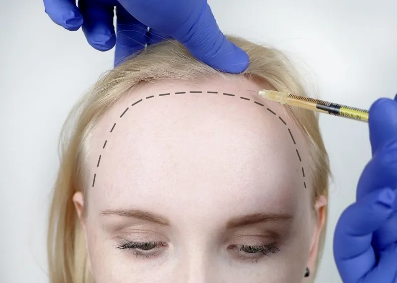 A technician prepares extracted hair grafts for implantation during a transplant procedure.