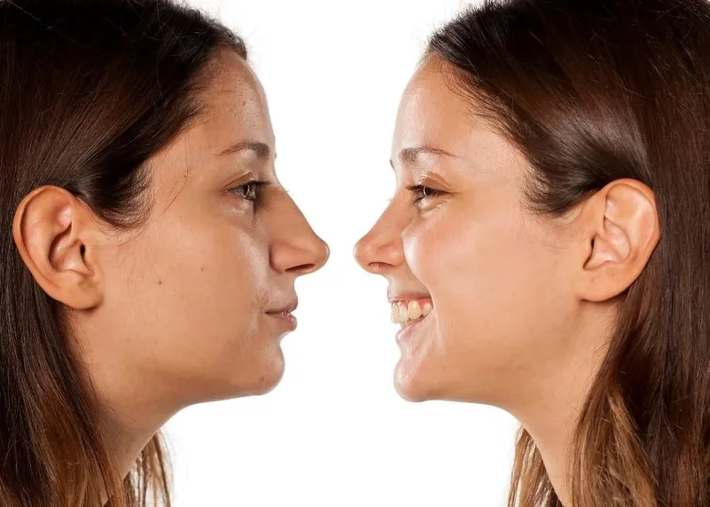 Surgical team performing an open rhinoplasty procedure in an operating room.