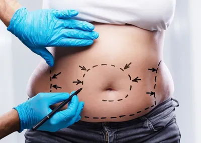 Mommy Makeover in Istanbul: Procedures, Recovery and Cost