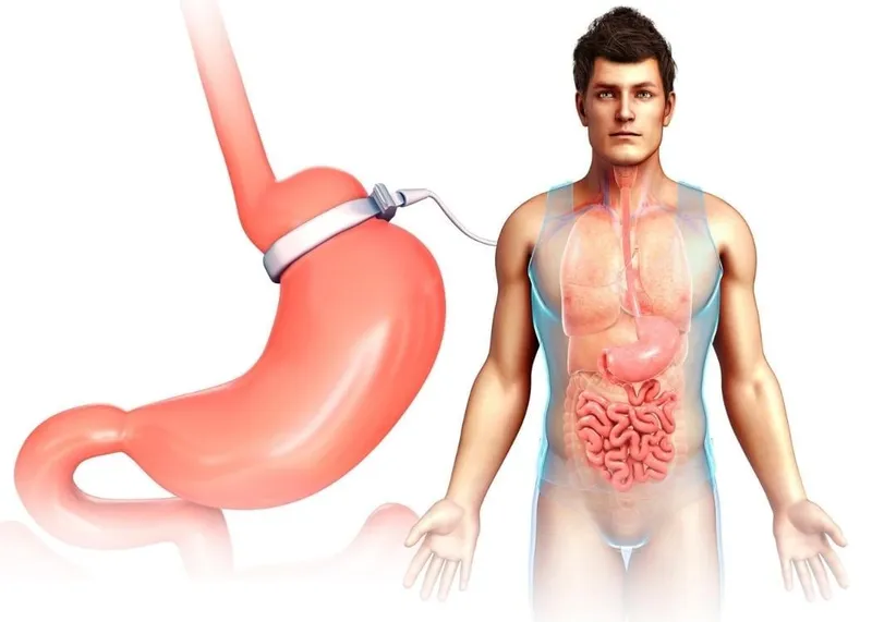 Bariatric surgeon discussing gastric band revision options with a patient