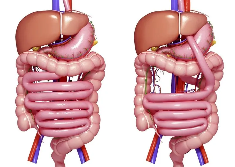 Surgical team preparing for a conversion from sleeve gastrectomy to gastric bypass