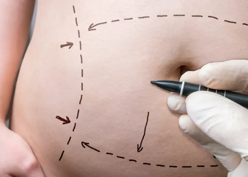Body aesthetics procedures offered at TrustMed Clinic in Istanbul