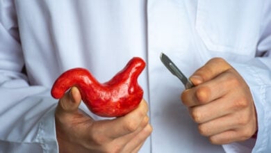 Revisional Bariatric Surgery Istanbul, Turkey